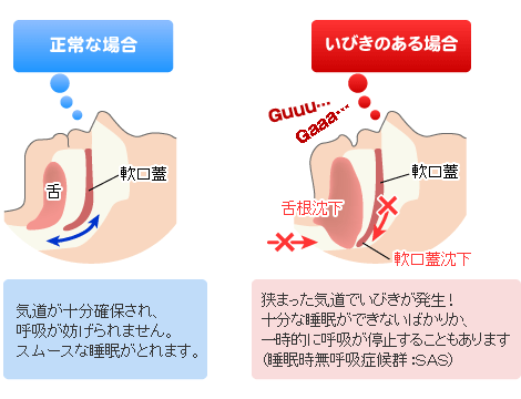 sleepsplint_01